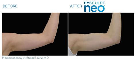 Myers, FL, for their treatment. . Emsculpt neo arms before and after